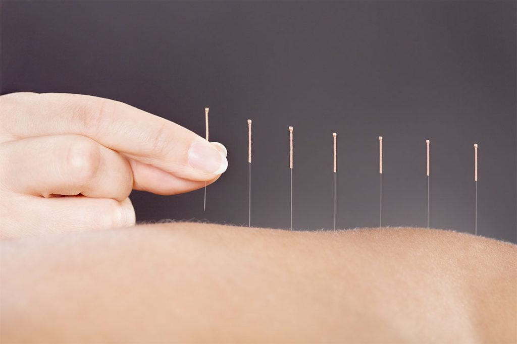 hand applying acupuncture needlese